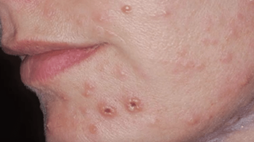 Infeksion mykotik i lëkurës në fytyrë