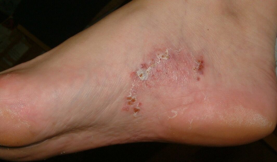 Manifestimet e një infeksioni mykotik në këmbë