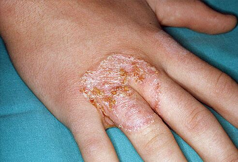 Njolla të kuqe në formë gjerdani në lëkurën e duarve për shkak të mykozës